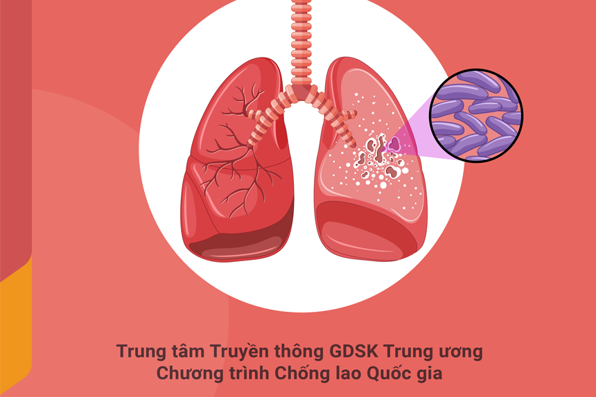 30 câu hỏi về lao